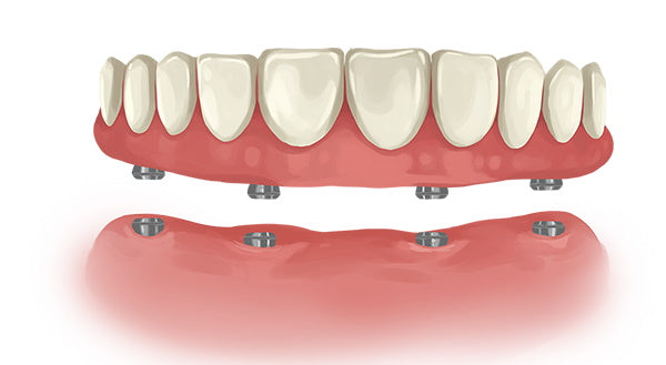 High-Precision 3D Printed Permanent Dentures
