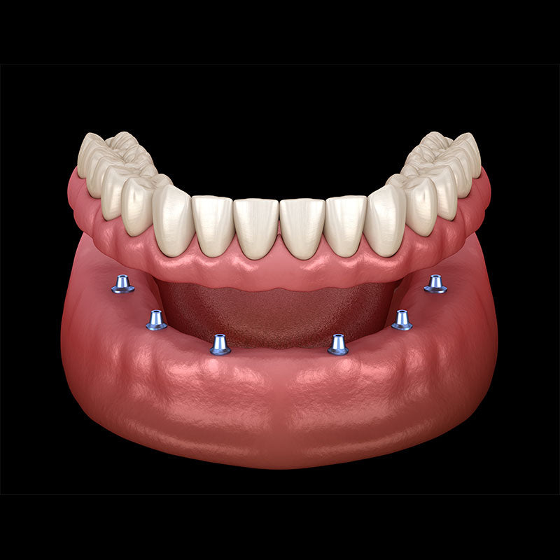High-Precision 3D Printed Permanent Dentures