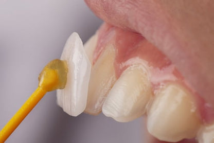 High-Precision 3D Printed Dental Veneers