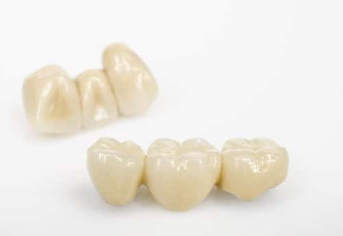 High-Precision 3D Printed Tooth Crowns and Bridges
