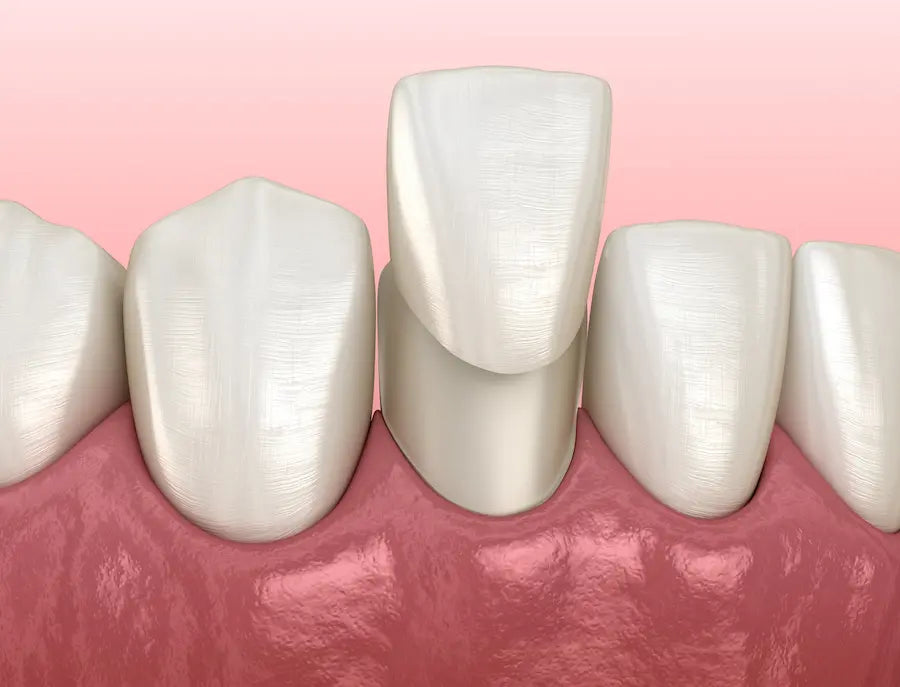 High-Precision 3D Printed Dental Veneers