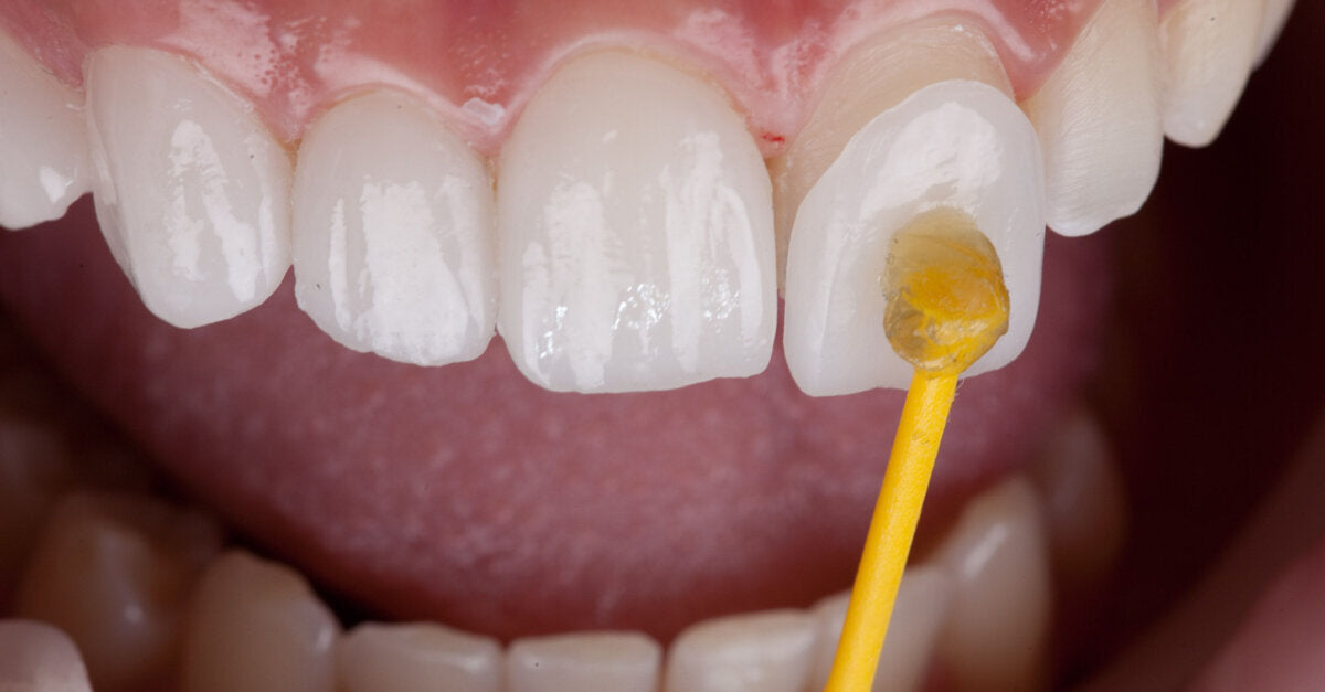 High-Precision 3D Printed Dental Veneers