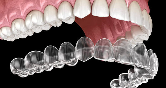 High-Precision 3D Printed Tooth Alignment Orthodontics