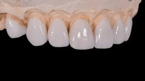 High-Precision 3D Printed Dental Veneers