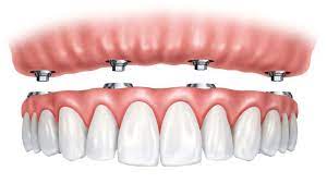 High-Precision 3D Printed Permanent Dentures