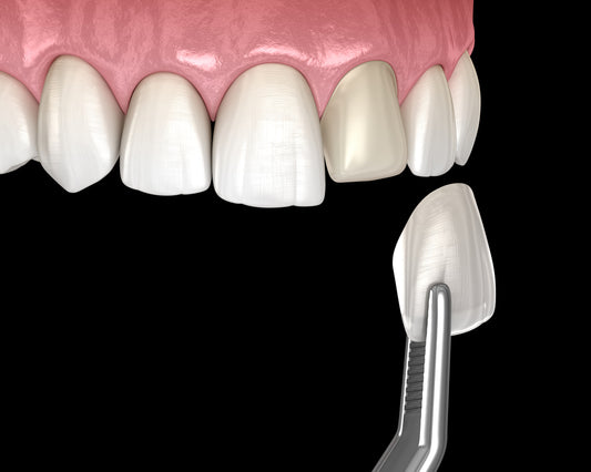 High-Precision 3D Printed Dental Veneers